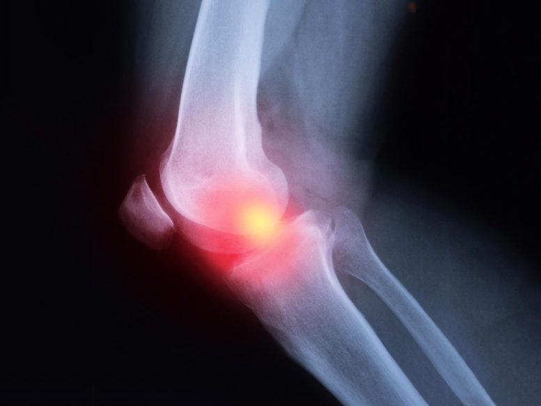 Arthritis Knee Pain X-ray Illustration - Breakthrough In Arthritis Treatment: JAK Inhibitors Prove Highly Effective In Japanese Study
