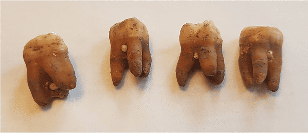 Some of the molars found by the researchers. - Viking Teeth Show Signs Of Complex Medieval Dentistry