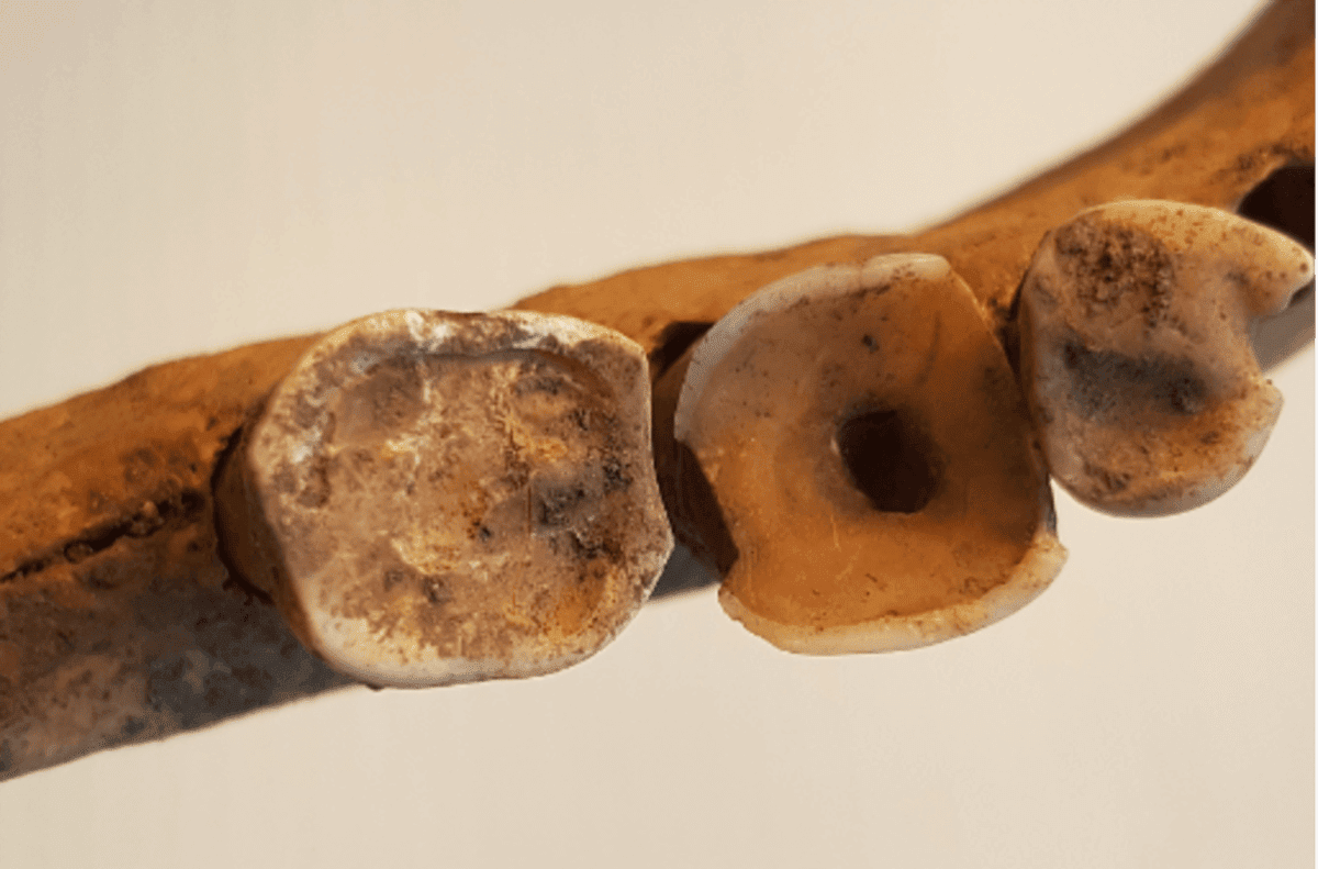 Viking Teeth Show Signs Of Complex Medieval Dentistry