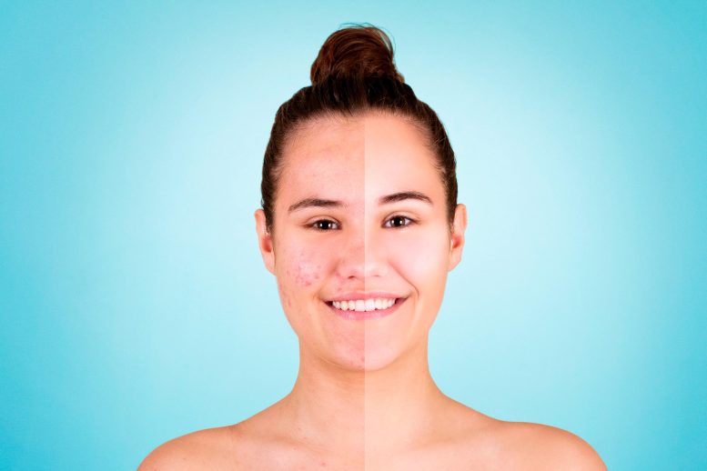 Before And After Acne Treatment - Biotech Breakthrough: Smart Skin Bacteria Engineered To Treat Acne