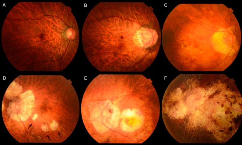 Fundus Photographs Showing Different Types of Myopic Maculopathy - Machine Learning Predicts Sight Loss: A Breakthrough In Eye Health