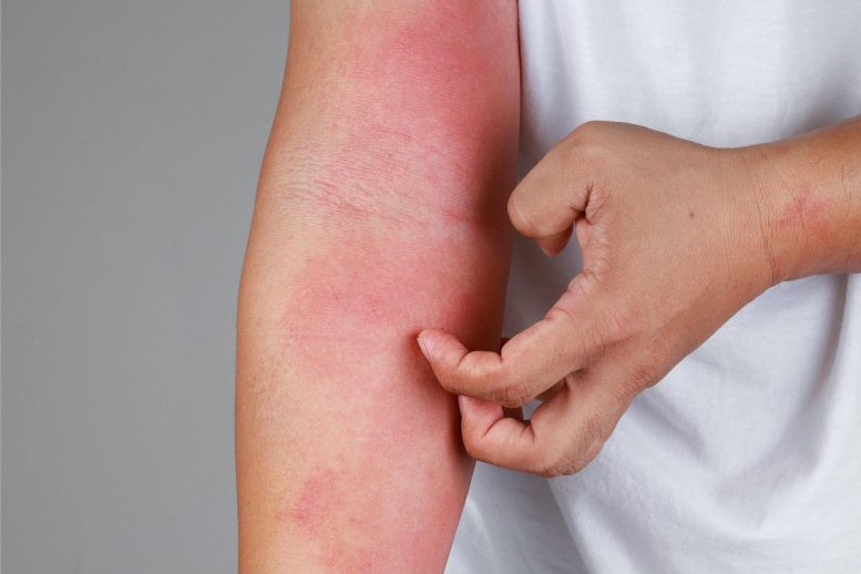 Eczema Arm Allergy Skin Concept - New Method Prevents Allergic Reactions Without Causing Side Effects