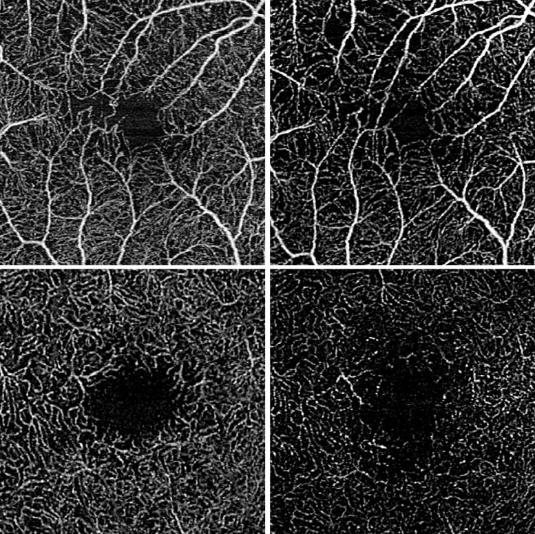 Ocular Vascular Perfusion in Intermediate Uveitis - Revolutionary Imaging Technique Offers New Hope For Eye Disease Patients