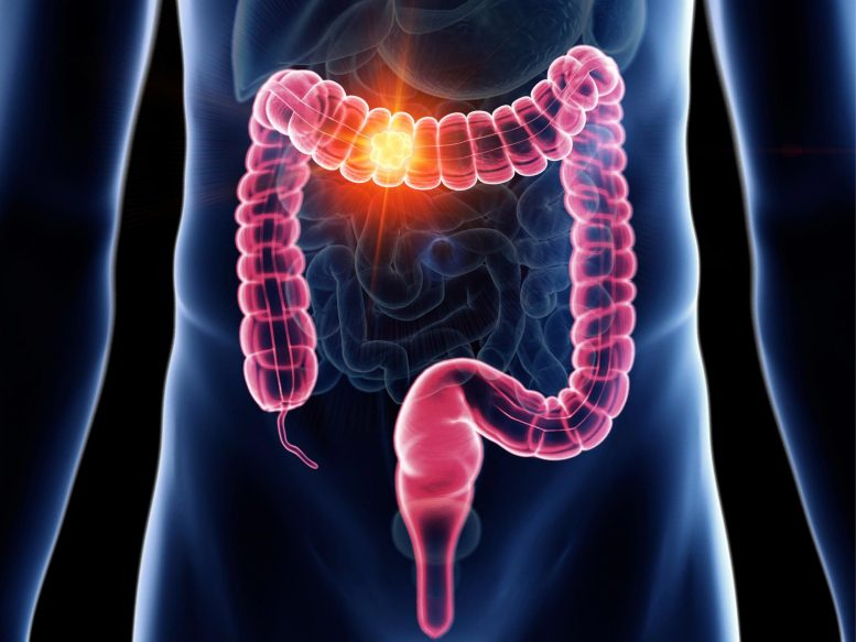Man Colon Cancer - Decoding Efficacy: MIT Unveils The Surprising Truth About Colon Cancer Screenings