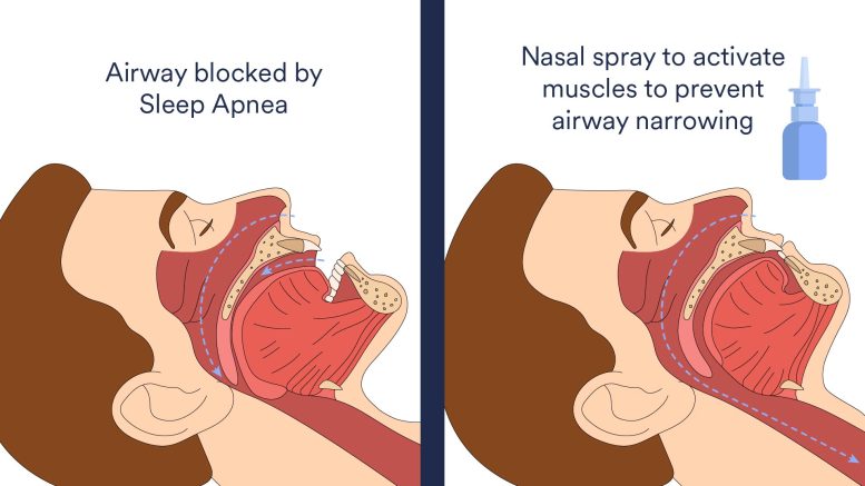 Sleep Apnea Nasal Spray - Snore No More: Unlocking Sleep Apnea Relief With Innovative Nasal Spray