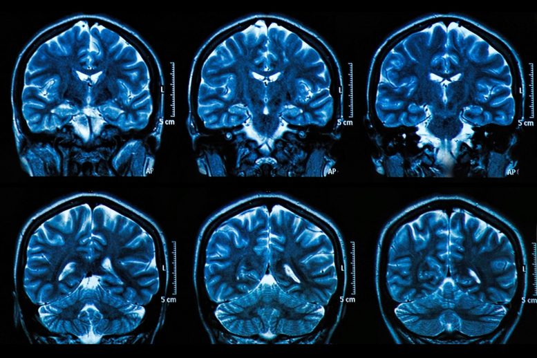 Brain Scan MRI Images - Unlocking The Secrets Behind Age-Related Memory Loss