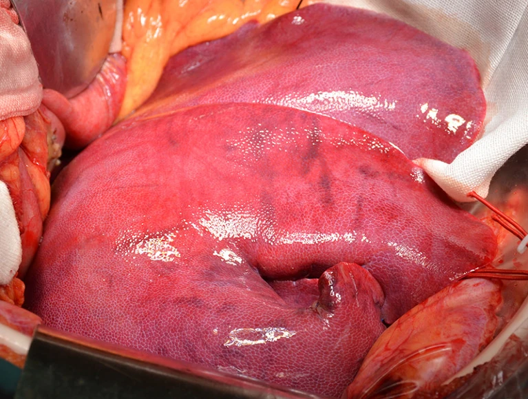 A close-up view of the pig liver during the xenotransplantation - First Successful Pig Liver Transplant In Human Marks New Era In Medicine