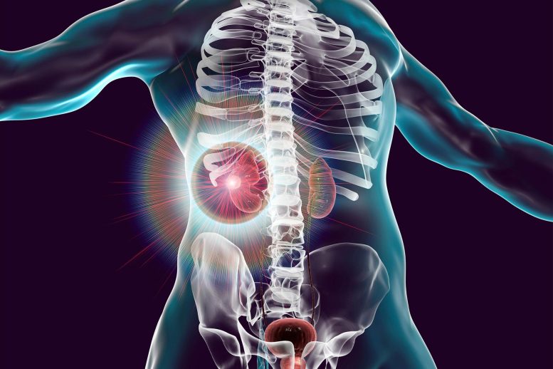 Kidney Cancer Treatment Concept - Scientists Have Discovered A “Powerhouse” Gene, Opening Doors To New Treatments For Kidney Disease