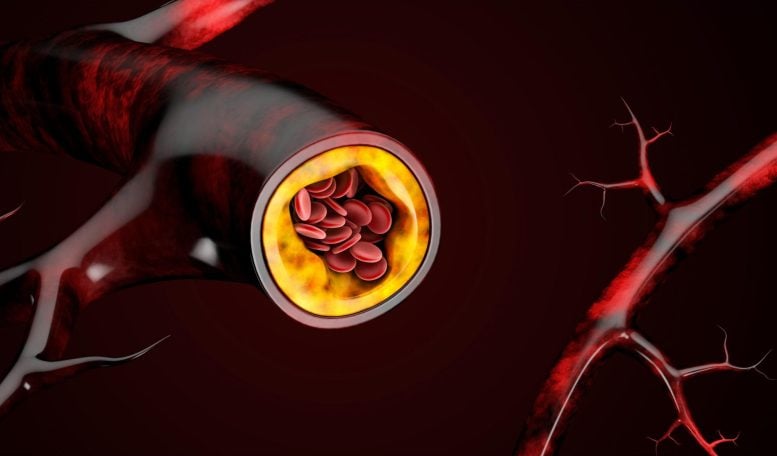 Blood Cells Cholesterol Accumulation - According To Scientists, Making This Simple Dietary Switch Can Reduce Bad Cholesterol Levels By 10%