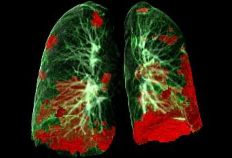 Lung Autopsies of COVID-19 Patients Reveal How Virus Spreads and Damages Tissue, Treatment Clues