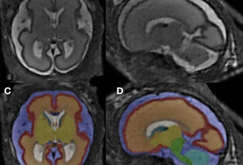 MRI Reveals Significantly Altered Brain Structure in Fetuses Exposed to Alcohol