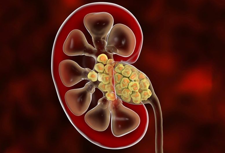 Climate Change Will Lead To Increase in Kidney Stones?!
