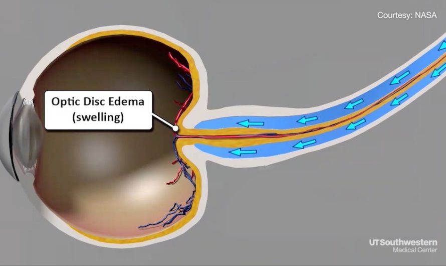 A Suctioning Sleeping bag Could Solve eye Problems in Space