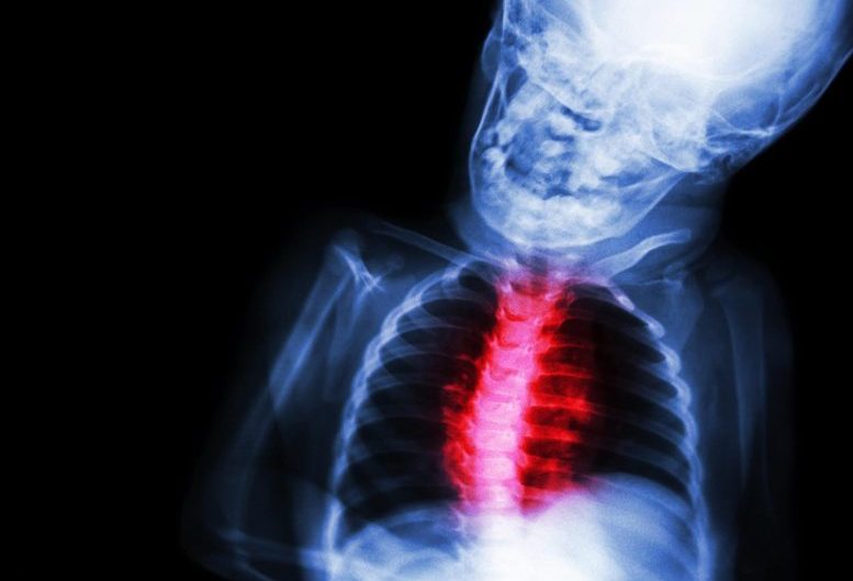 Heart Function Recovered Quickly in Children With COVID-19-Related Multisystem Inflammatory Syndrome